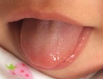 舌头代表宝宝身体内部的症状!
