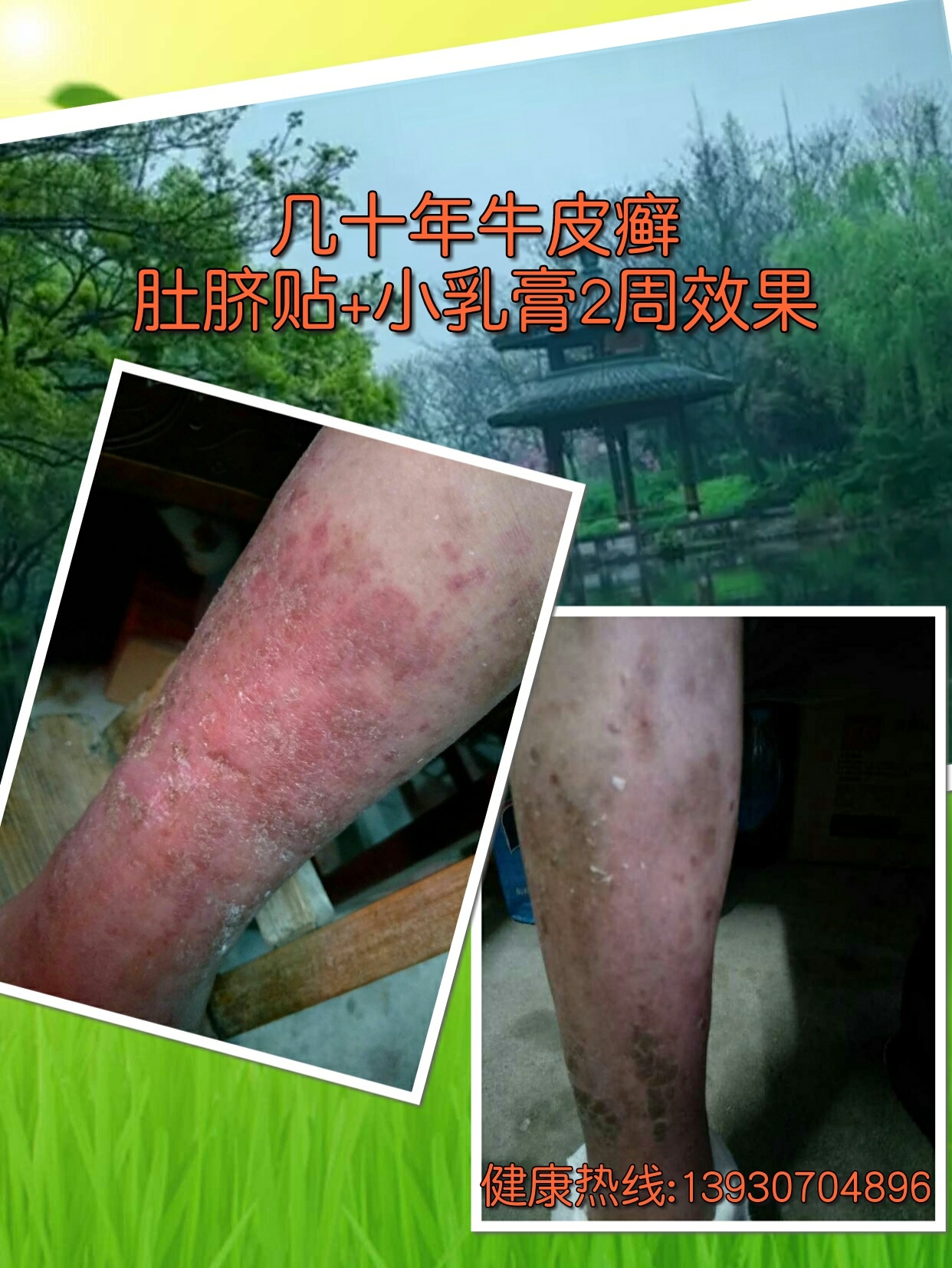 牛皮癣的治疗是难题吗63no60