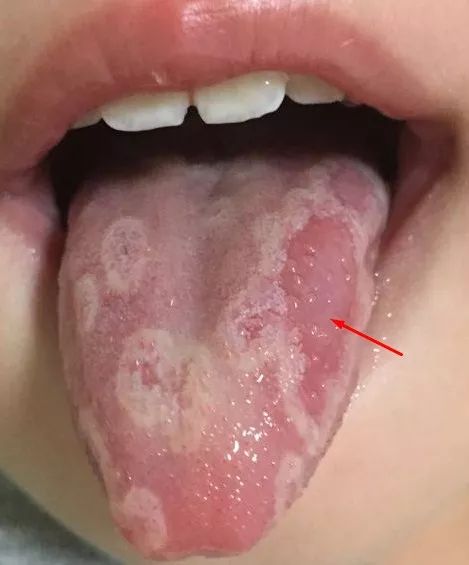 舌头代表宝宝身体内部的症状