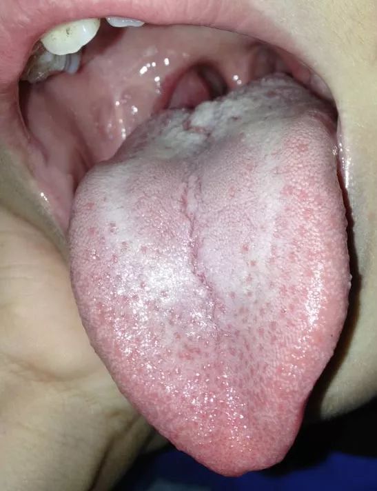 舌头后部有小肉疙瘩图片