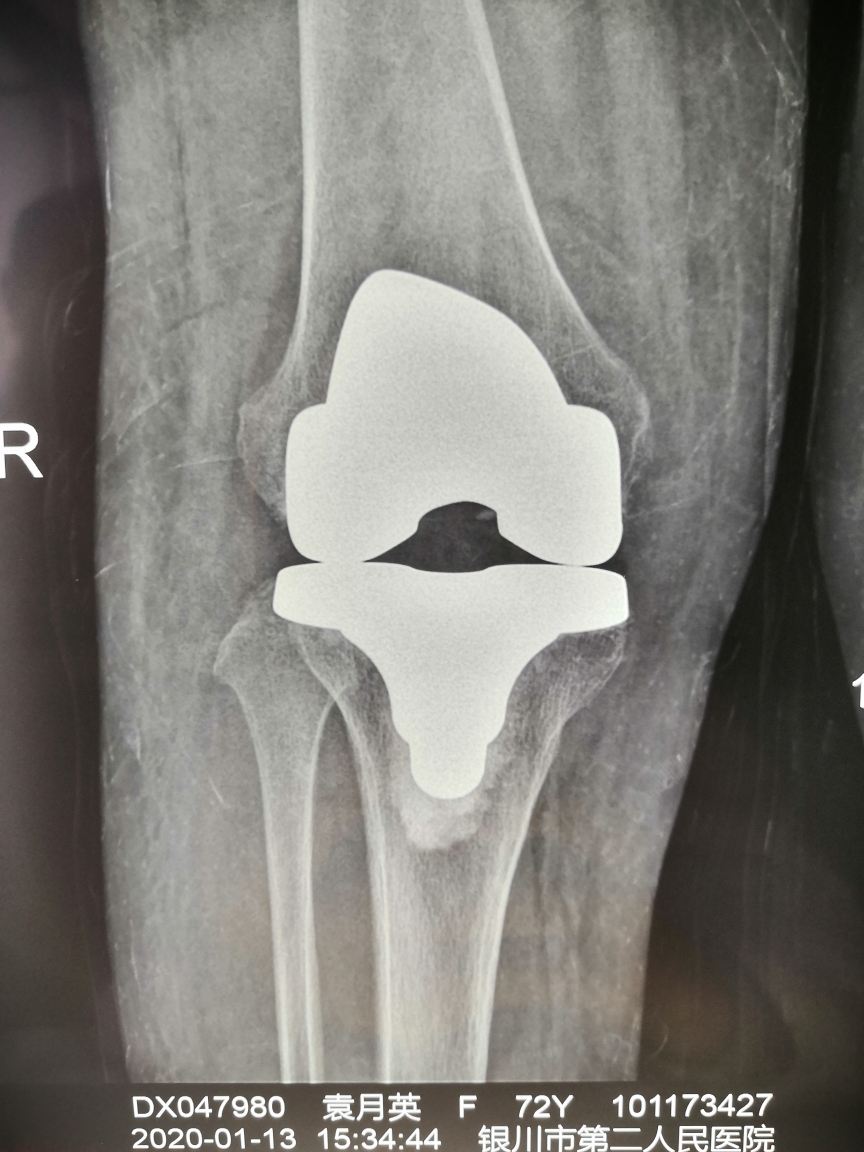 银川市第二人民医院成功完成一例膝关节外翻合并屈曲挛缩畸形病人全膝