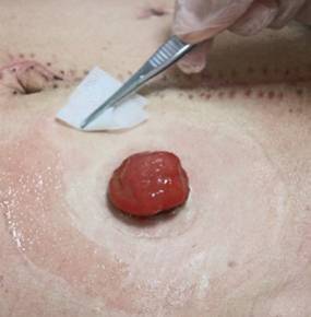 造口袋的更换流程及注意事项