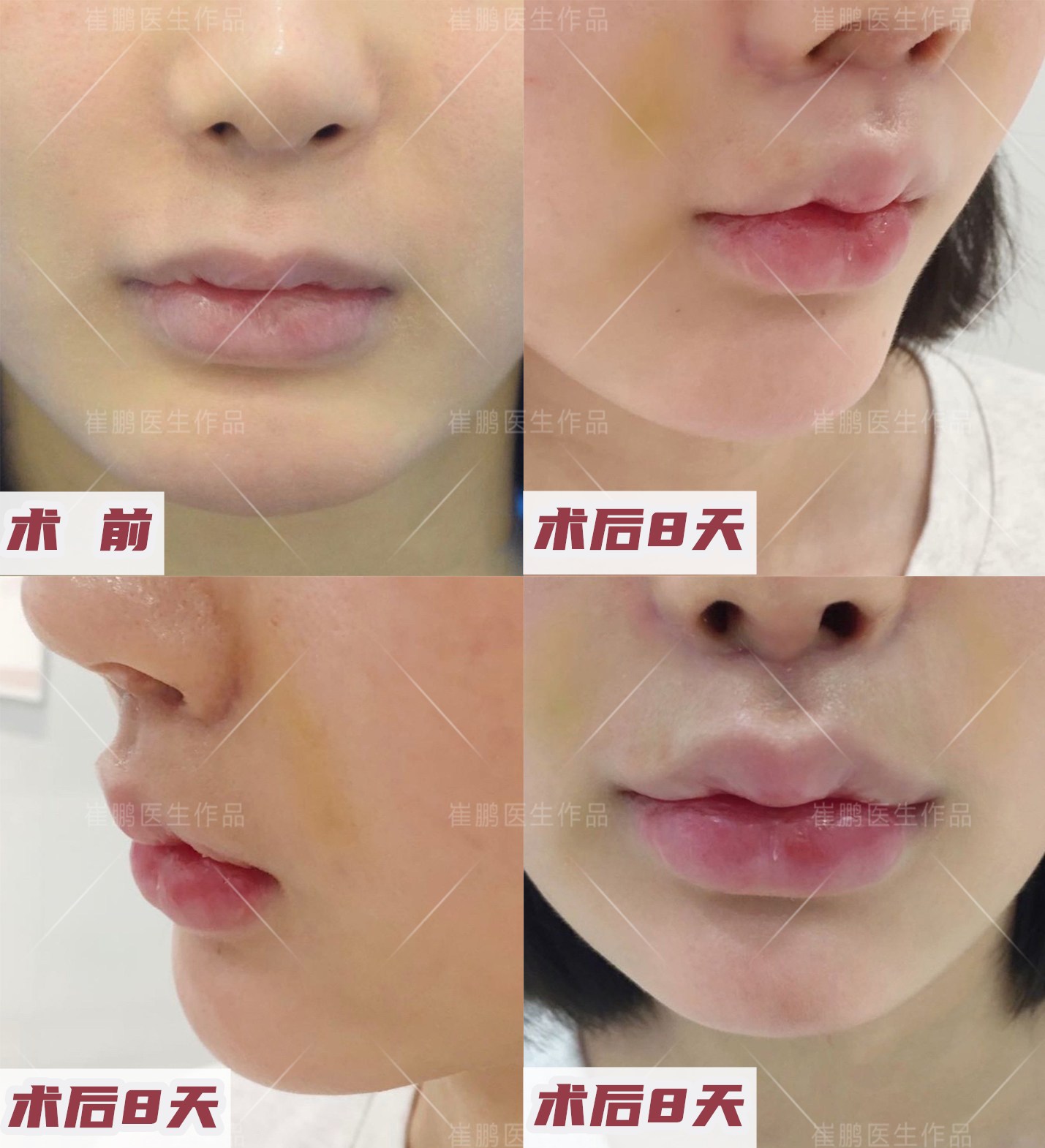 人中缩短术的操作步骤是怎么样的