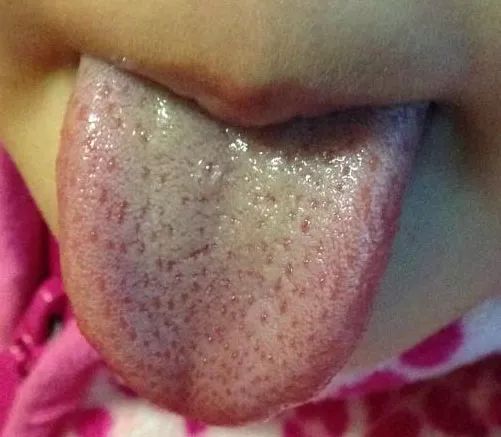 宝宝盘舌头的症状图片图片